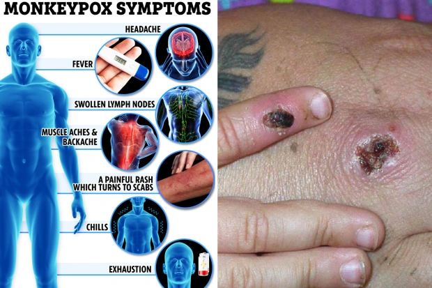 What Are the Symptoms of Monkeypox Virus? » Expat Guide Turkey