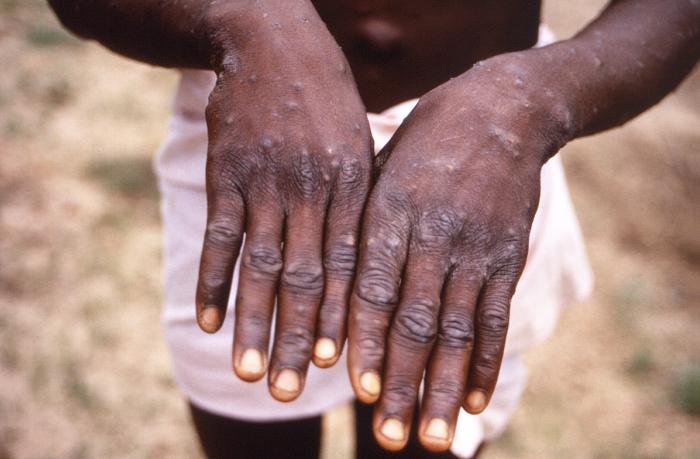 monkeypox symptoms - photo #24