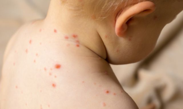 Monkeypox Is More Dangerous To Children" » Expat Guide Turkey