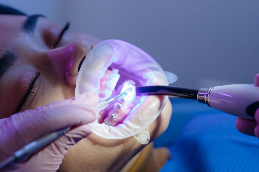 how to remove braces at home